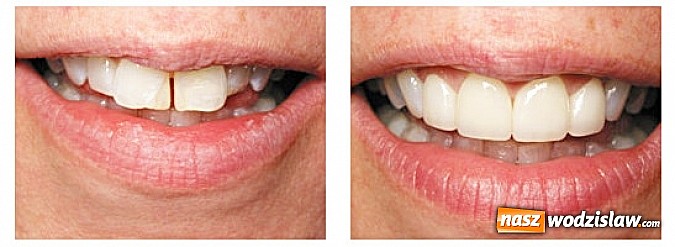 Zdjęcie w galerii na portalu naszwodzislaw.com: Licówki porcelanowe – sposób na piękny uśmiech wiadomości z regionu