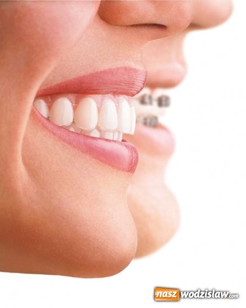 Zdjęcie w galerii na portalu naszwodzislaw.com: Niewidoczne aparaty ortodontyczne wiadomości z regionu