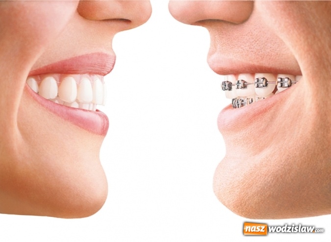 Zdjęcie w galerii na portalu naszwodzislaw.com: Niewidoczne aparaty ortodontyczne wiadomości z regionu